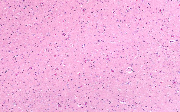 5A Neuronophagia (Case 5) no virus, likely Hypoxia N4 H&E 4