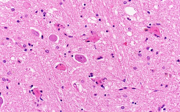 5B Neuronophagia (Case 5) no virus, likely Hypoxia N4 H&E 12