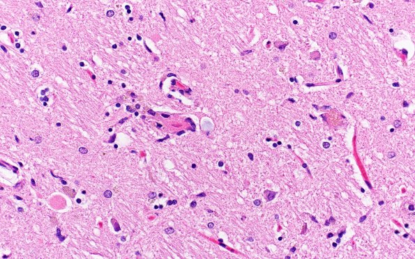 5C Neuronophagia (Case 5) no virus, likely Hypoxia N4 H&E 10