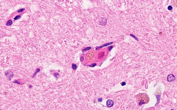 5D Neuronophagia (Case 5) no virus, likely Hypoxia N4 H&E 100X 1