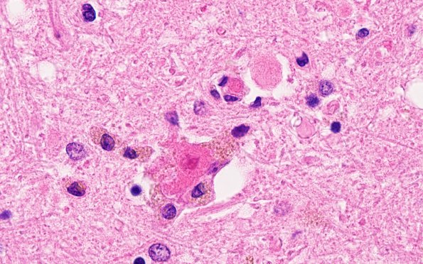 5E Neuronophagia (Case 5) no virus, likely Hypoxia N4 H&E 100X 2