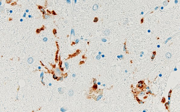 5F Neuronophagia (Case 5) no virus, likely Hypoxia CD68 40-60X 2