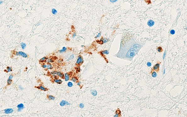 5H Neuronophagia (Case 5) no virus, likely Hypoxia CD68 100X 5