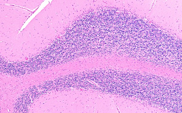 7A Hypoxia-Ischemia Neuronophagia (Case 7) H&E 9