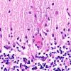 7B Hypoxia-Ischemia Neuronophagia (Case 7) H&E 4