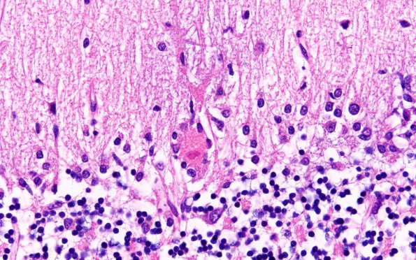 7B Hypoxia-Ischemia Neuronophagia (Case 7) H&E 4