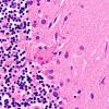 7C Hypoxia-Ischemia Neuronophagia (Case 7) H&E 7