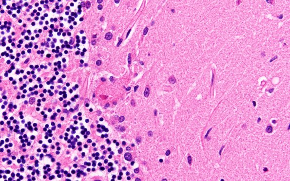7C Hypoxia-Ischemia Neuronophagia (Case 7) H&E 7