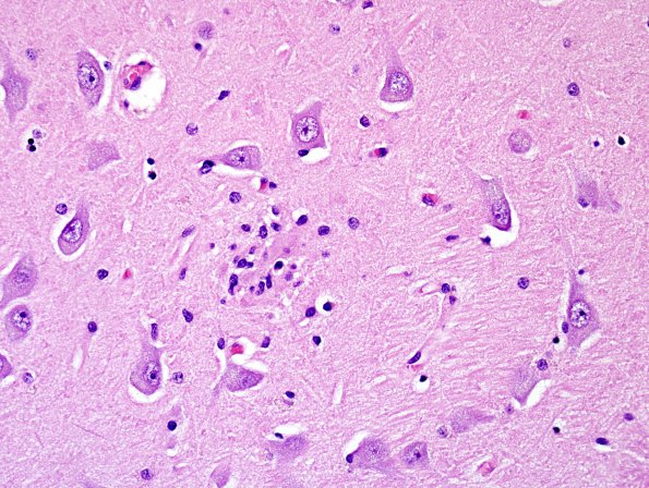 8 Encephalitis, west nile (Case 8) H&E 1