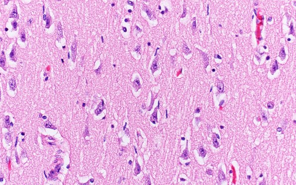 9 Microglia, early neuronophagia (Case 9) H&E 3A