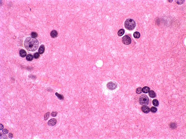 11 Oligodendroglia, satelliting, normal H&E 1