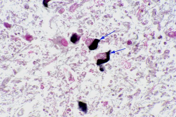 13 Oligodendroglia, GCI, Multiple Systems Atrophy, Gallyas 2A