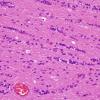 14 Satelliting Oligodendroglia, exaggerated (Case 7) H&E 2