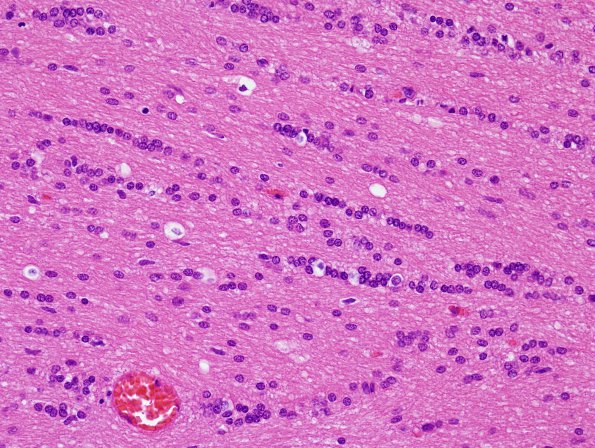 14 Satelliting Oligodendroglia, exaggerated (Case 7) H&E 2