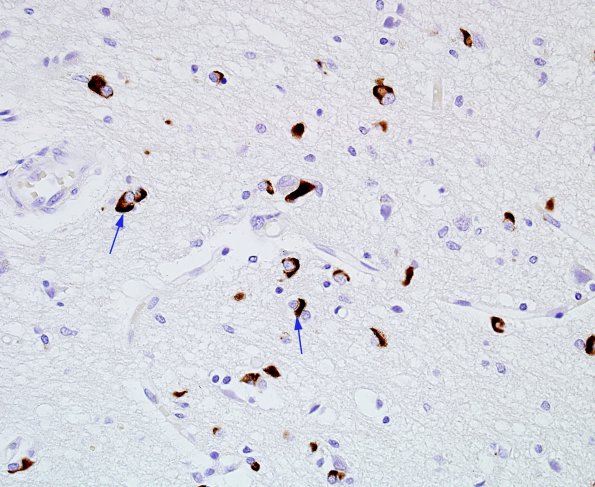 16 Glial Cytoplasmic Atrophy (Multiple system atrophy, Case 10) Midbrain pSYN 1