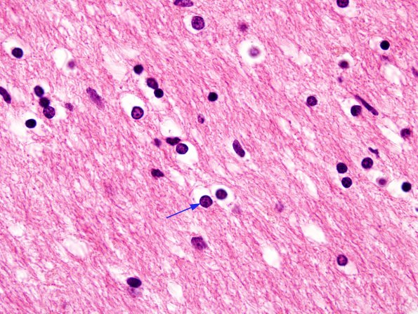 2 Oligodendrocyte (Case 2) 100X H&E 1