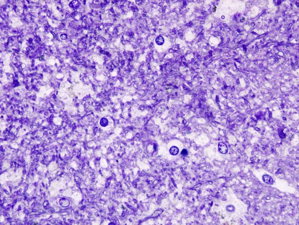 3 Oligodendrocyte (Case 11) Plastic 1