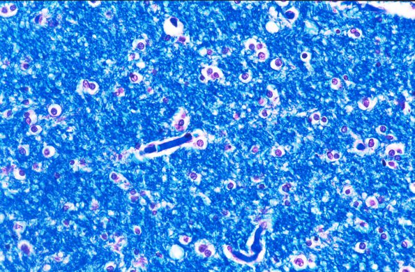 6 Oligodendroglia, normal LFB-PAS 2