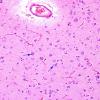 7 Oligodendroglia, non-neoplastic satelliting (Case 4) H&E 3