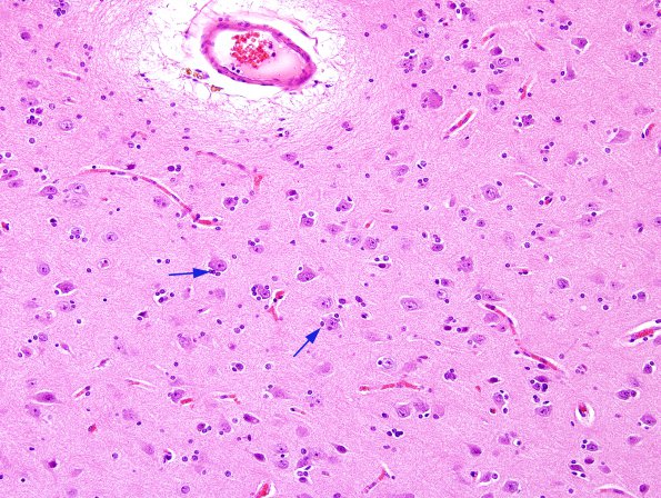 7 Oligodendroglia, non-neoplastic satelliting (Case 4) H&E 3