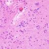 9 Oligodendroglia, non-neoplastic satelliting (Case 4) H&E 2