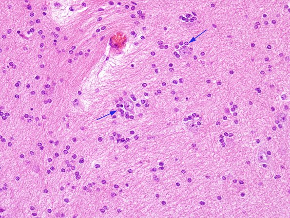 9 Oligodendroglia, non-neoplastic satelliting (Case 4) H&E 2