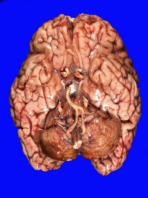 10A1 Infarcts, multiple, Olive HT (Case 12)_1