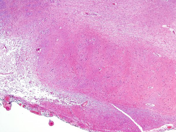 10C2 Infarcts, multiple, Olive HT (Case 12) H&E 1