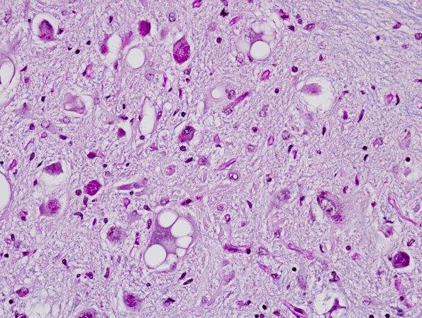 10D2 Infarcts, multiple, Olive HT (Case 12) LFB-PAS 2