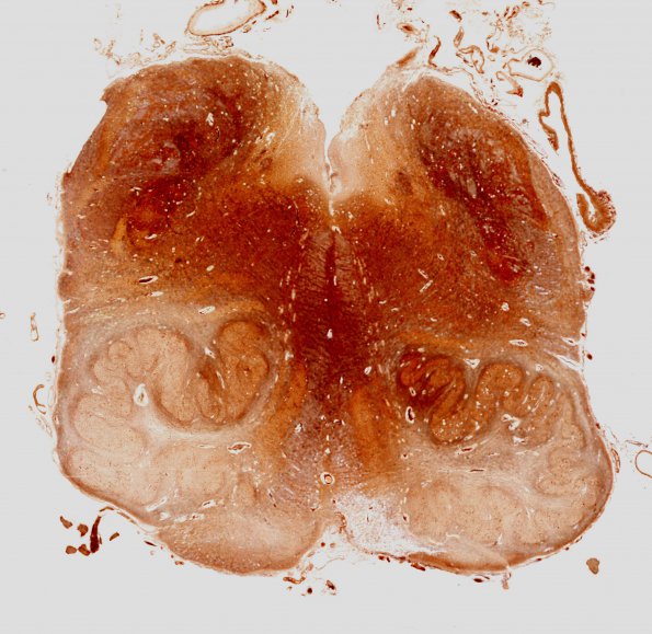 10E1 Infarcts, multiple, Olive HT (Case 12) Biels WM