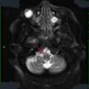 1A1 Olivary Hyperplasia (Case 2) unilateral MRI 3