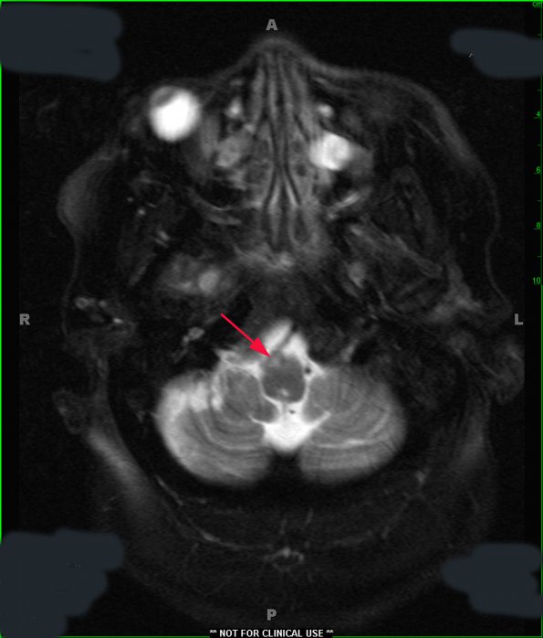 1A1 Olivary Hyperplasia (Case 2) unilateral MRI 3