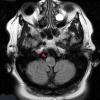 1A22 Olivary Hyperplasia (Case 2) unilateral T2 TIRM TRA dark-fluid