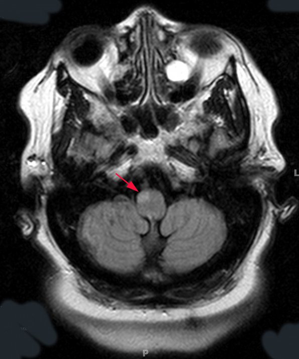 1A22 Olivary Hyperplasia (Case 2) unilateral T2 TIRM TRA dark-fluid