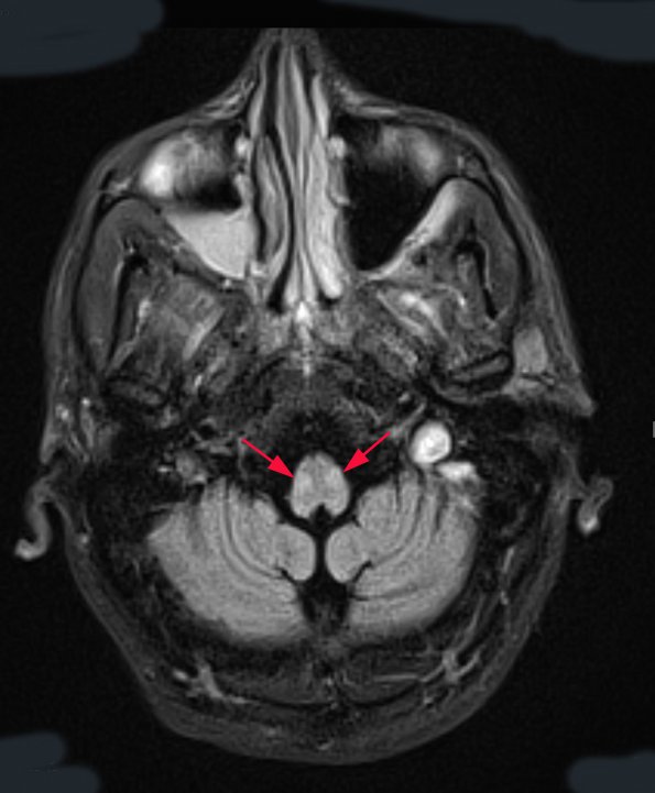 2 Olivary Atrophy, late stage of hyperplasia (Case 6) TRA FLAIR