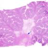 3B1 Olivary Hyperplasia (Case 1) H&E 11