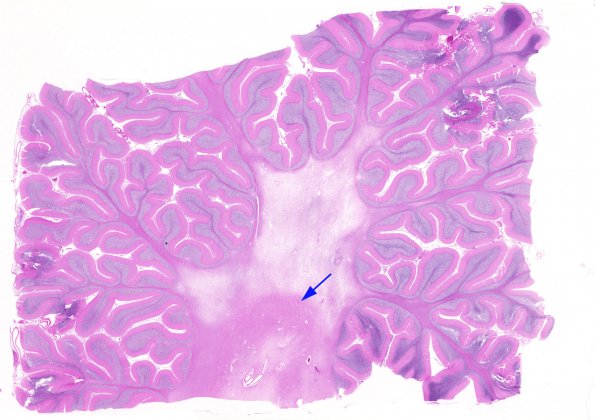 3B1 Olivary Hyperplasia (Case 1) H&E 11