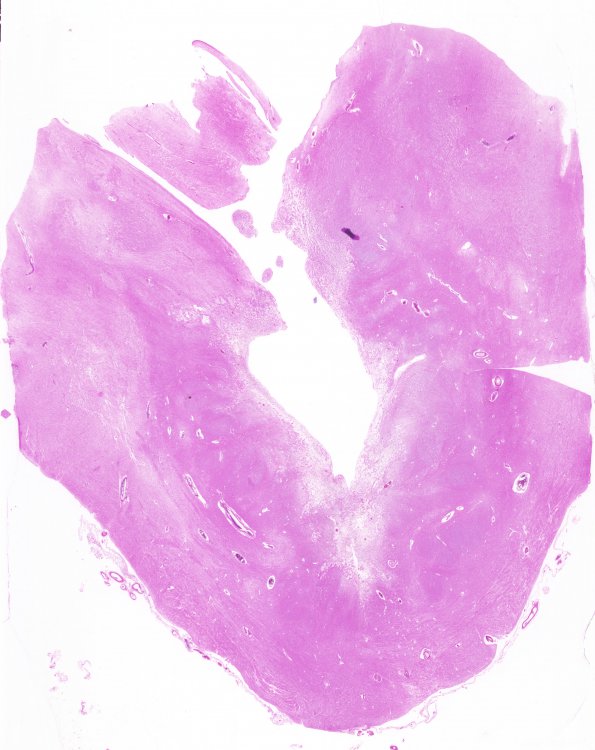 3B2 Olivary Hyperplasia (Case 1) N14 H&E 2