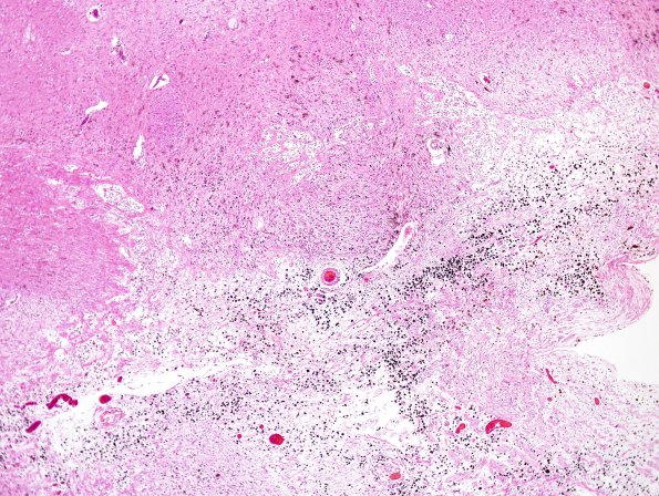 3B3 Olivary Hyperplasia (Case 1) N14 H&E 1