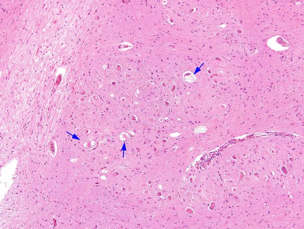 3B5 Olivary Hyperplasia (Case 1) H&E 8