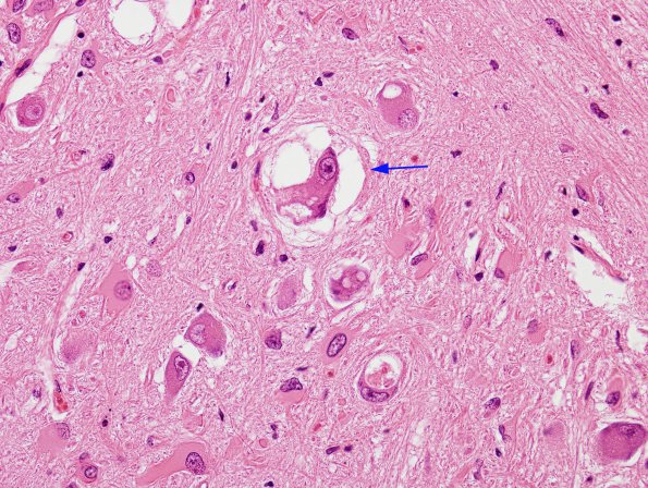 3B6 Olivary Hyperplasia (Case 1) H&E 1