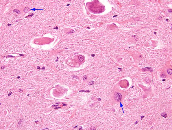 3B7 Olivary Hyperplasia (Case 1) H&E 2