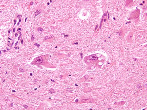 3B8 Olivary Hyperplasia (Case 1) H&E 3