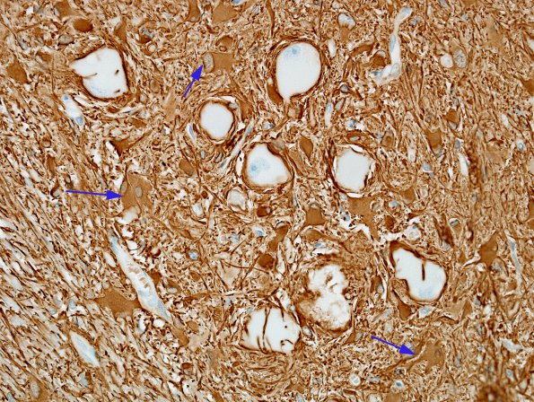 4 Telangiectasis & Olivary Hypertrophy (A15-17) GFAP 1