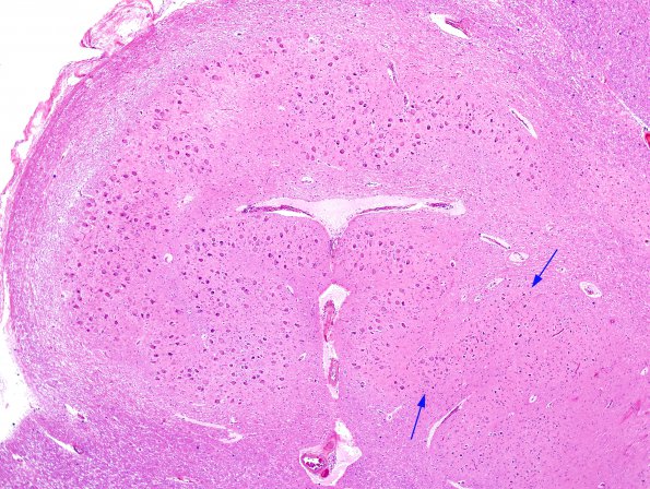 5A1 Olivary Hyperplasia (Case 3) A series H&E 4