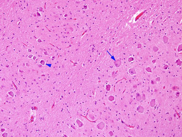 5A3 Olivary Hyperplasia (Case 3) A series H&E 3