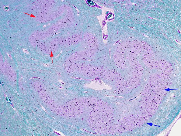 5B1 Olivary Hyperplasia (Case 3) A series LFB-PAS 3