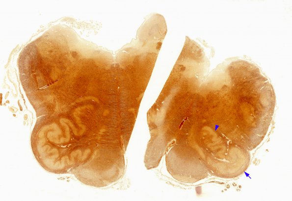 5C1 Olivary Hyperplasia (Case 3) Biels whole mount A