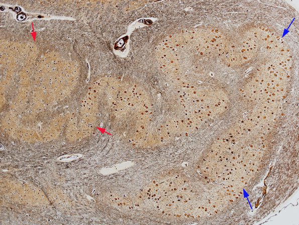 5C2 Olivary Hyperplasia (Case 3, L12) Biels 2