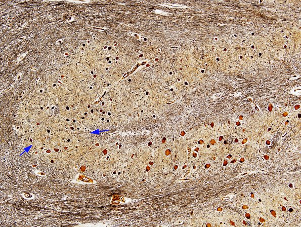 5C3 Olivary Hyperplasia (Case 3, L12) Biels 5